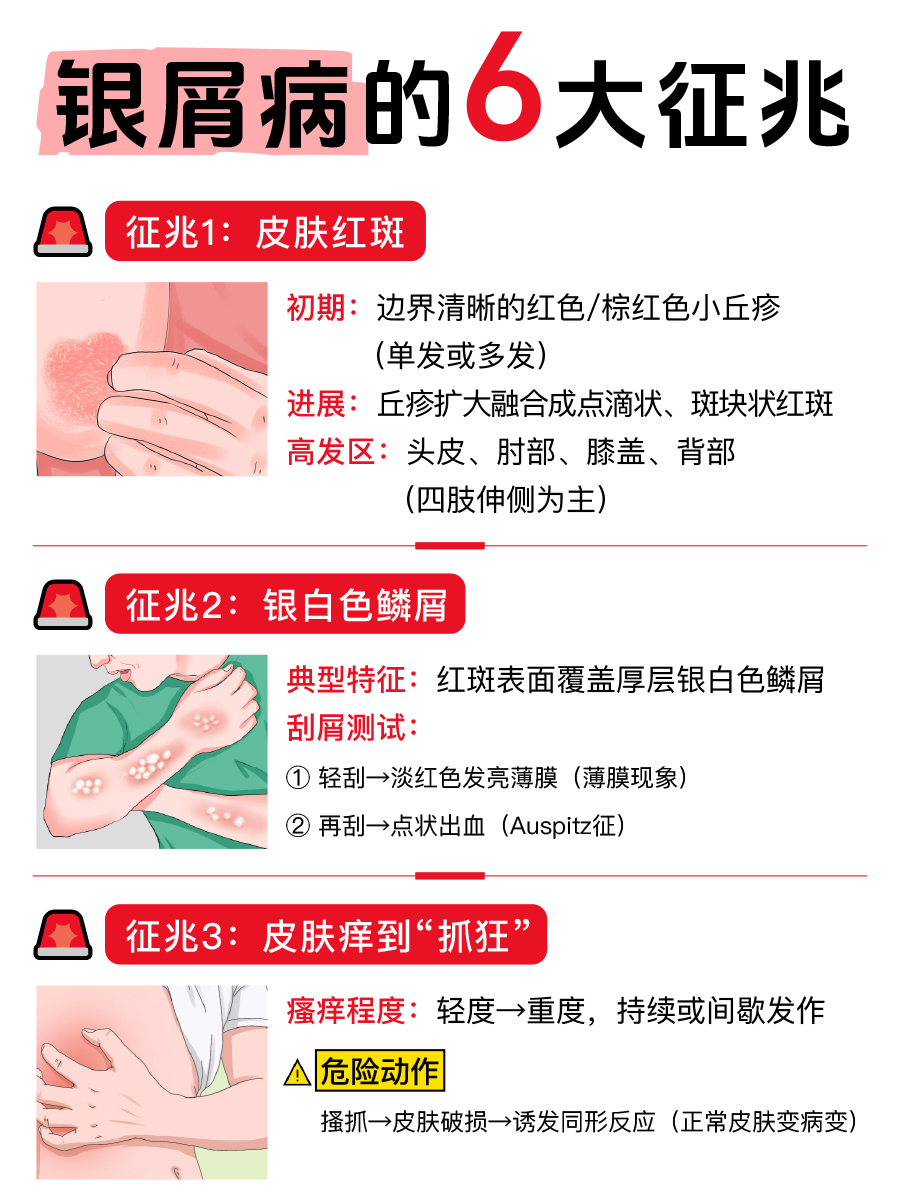 银屑病的6个征兆，速戳，看你有吗？？？