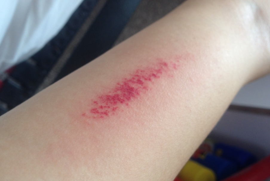 长期搔抓往往引起片状色素沉着或苔藓样化,抓伤的皮肤也容易继发感染