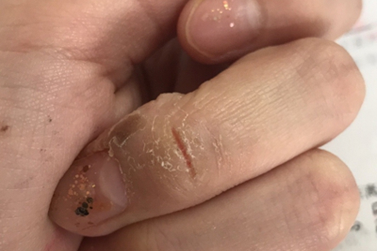 人工皮炎手部黄痂图