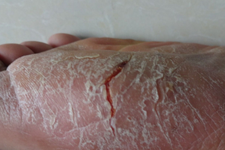 皲裂性湿疹脚底脱皮有裂口图