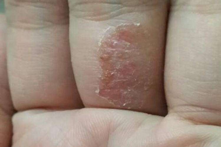 手接触水泥过敏结痂图