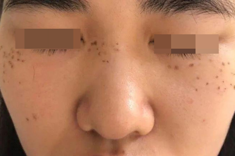 激光祛斑后痂皮脱落图