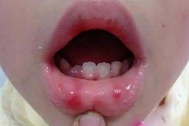 小儿疱疹性咽峡炎唇内侧红斑图 小儿疱疹性咽峡炎唇内侧红斑图