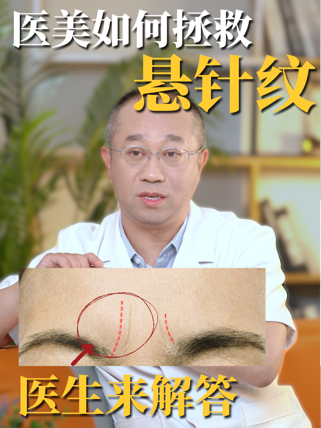 医美如何拯救悬针纹？医生来解答~