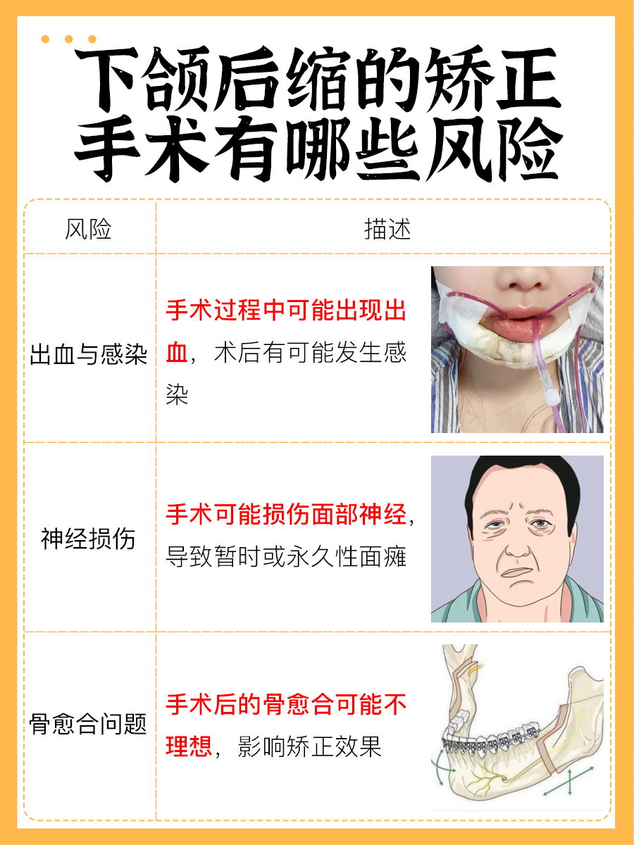 下颌后缩矫正攻略：医生告诉你