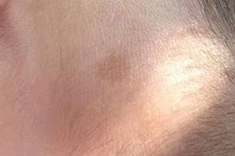 宝宝额头部淡褐色咖啡斑图