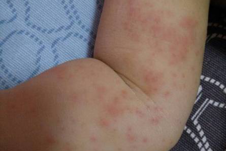 宝宝胳膊湿疹图