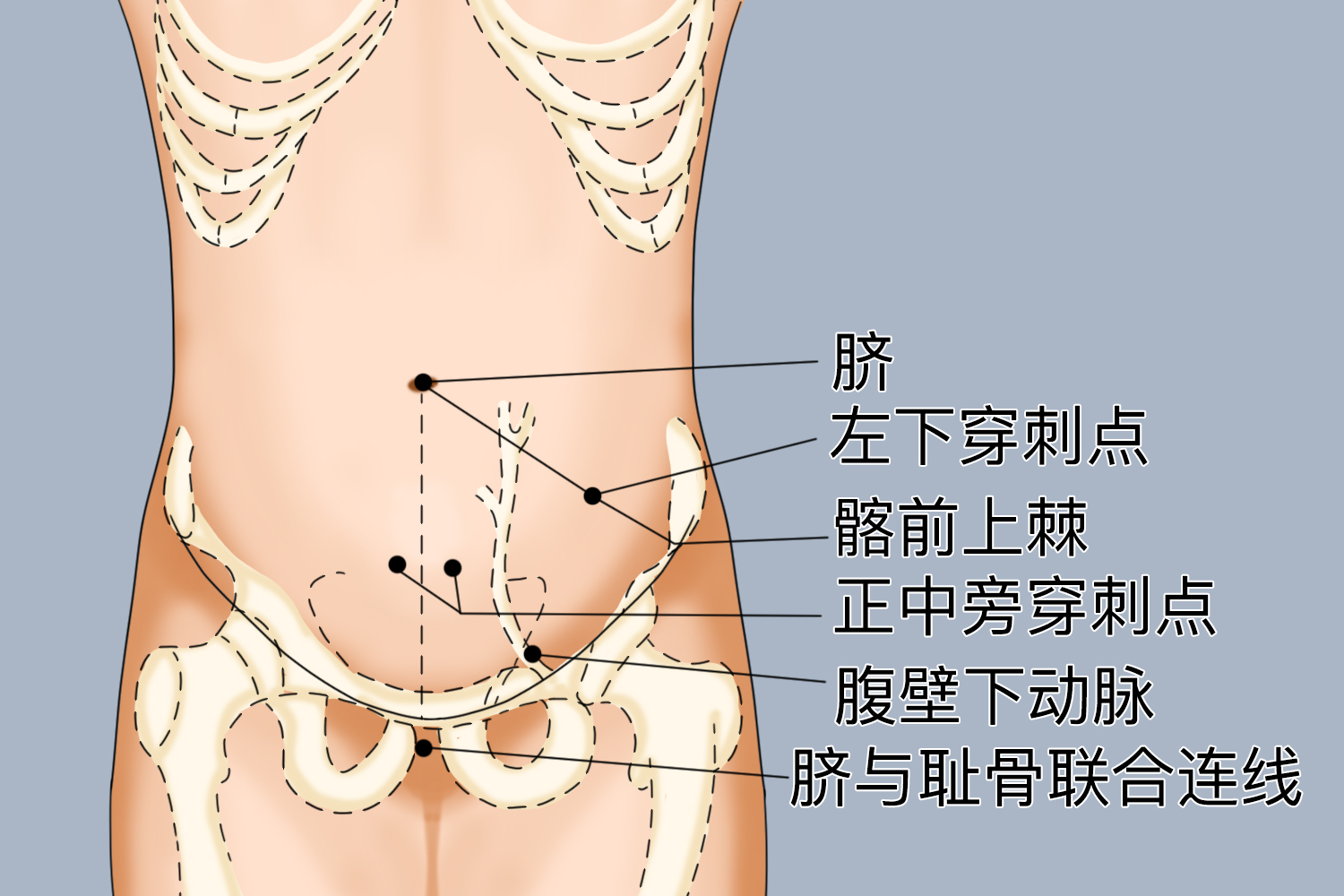 腹腔穿刺点示意图图片