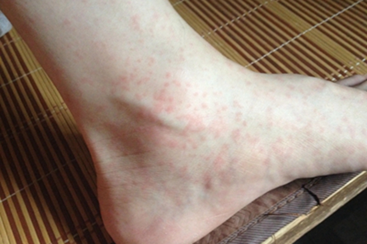 女性梅毒脚踝红点图 女性梅毒脚踝红点图