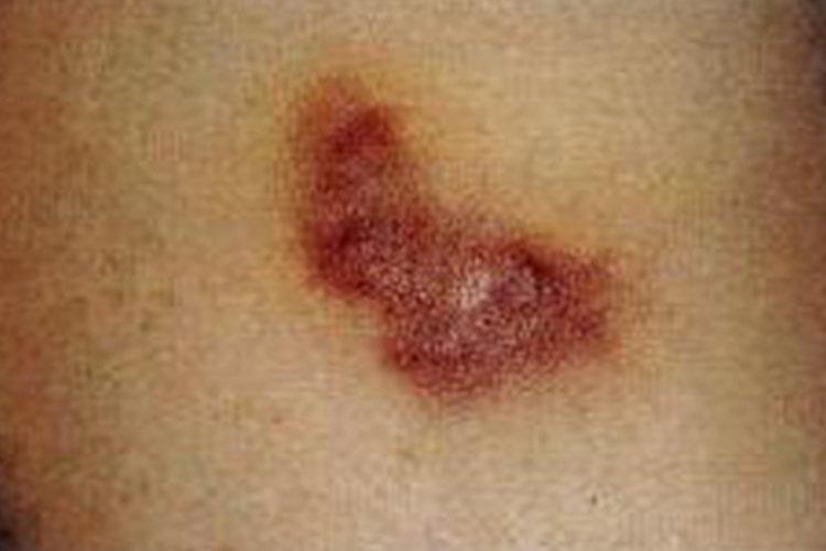 卡波西肉瘤初期粉红色斑疹图