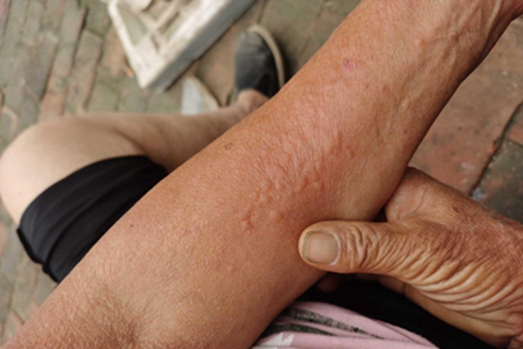 丘疹性荨麻疹胳膊症状图 丘疹性荨麻疹胳膊症状图