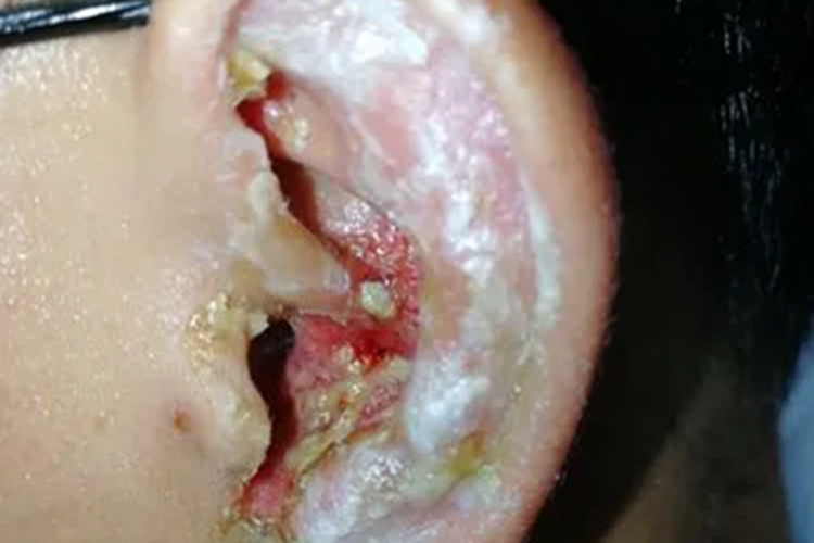 坏死性外耳道炎耳廓糜烂图 坏死性外耳道炎耳廓糜烂图