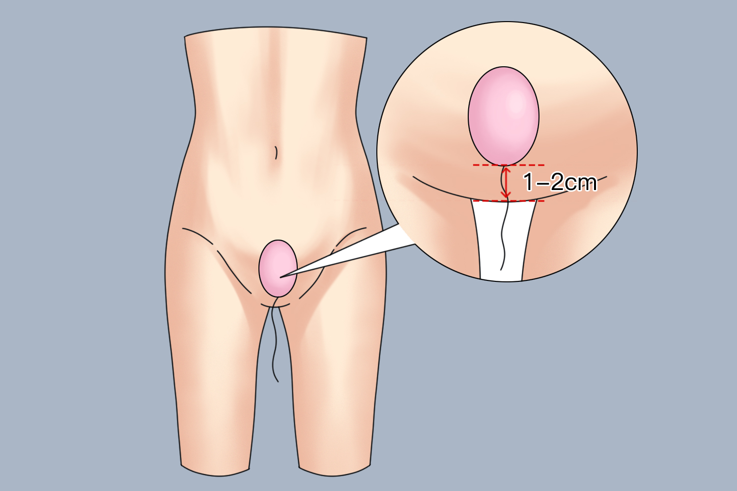 放置阴道哑铃图