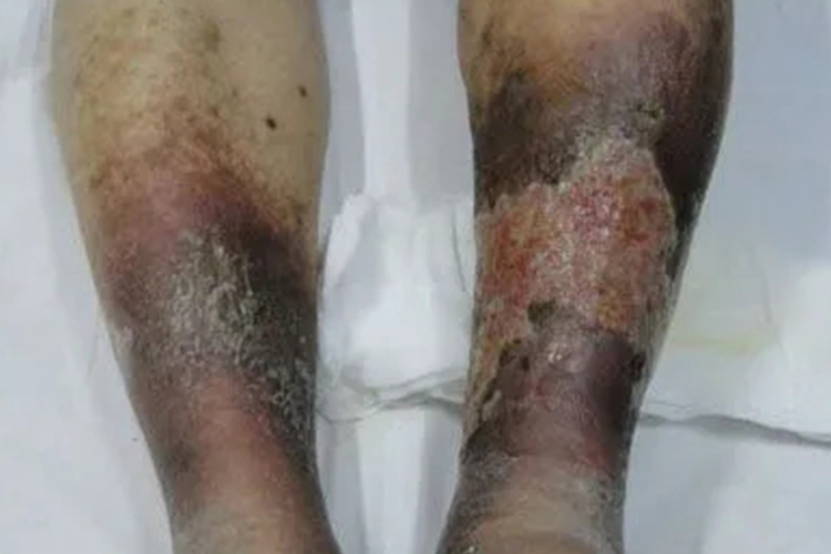 脉管炎腿烂了发黑图