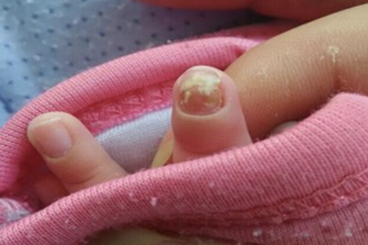 锌缺乏症手指甲凹凸不平图