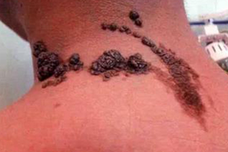 炎症型表皮痣肩部症状图 炎症型表皮痣肩部症状图