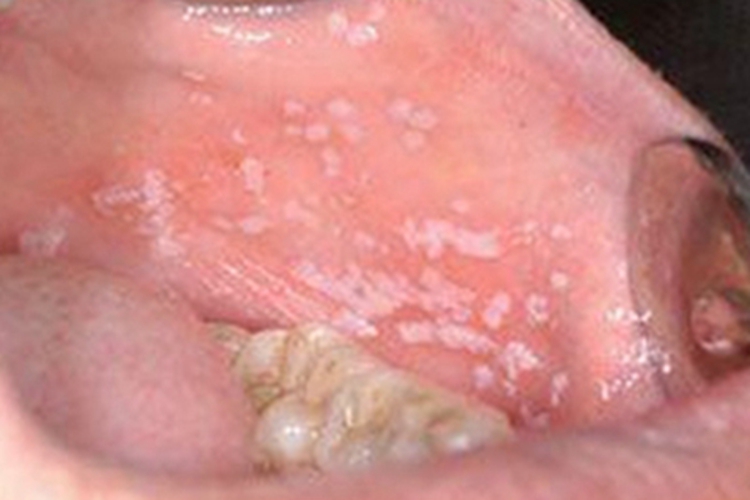 鹅口疮口腔白点图