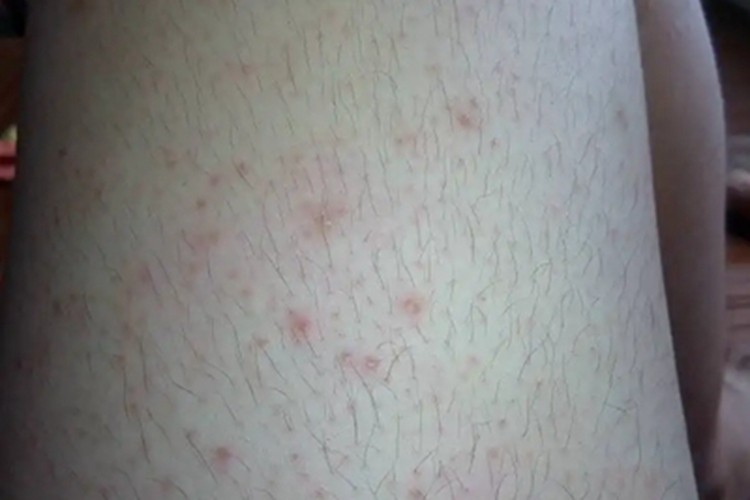 单纯性痒疹大腿丘疹图