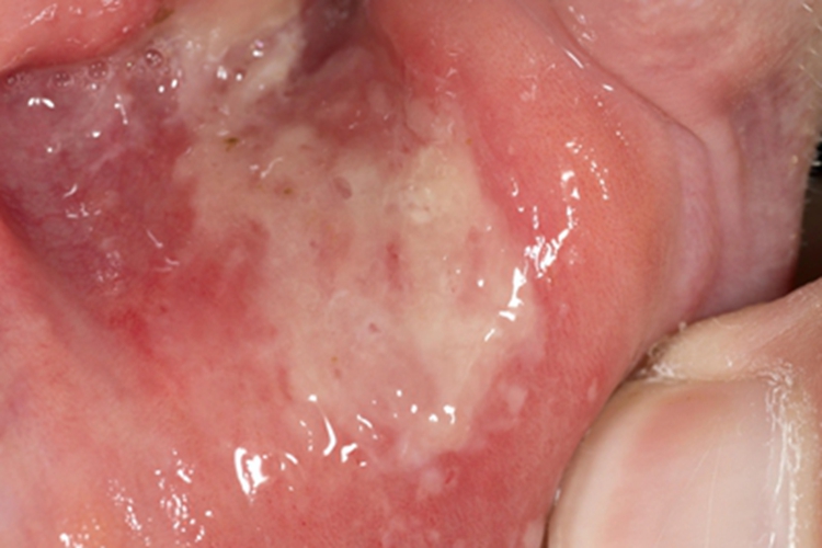 重型阿弗他溃疡口腔症状图