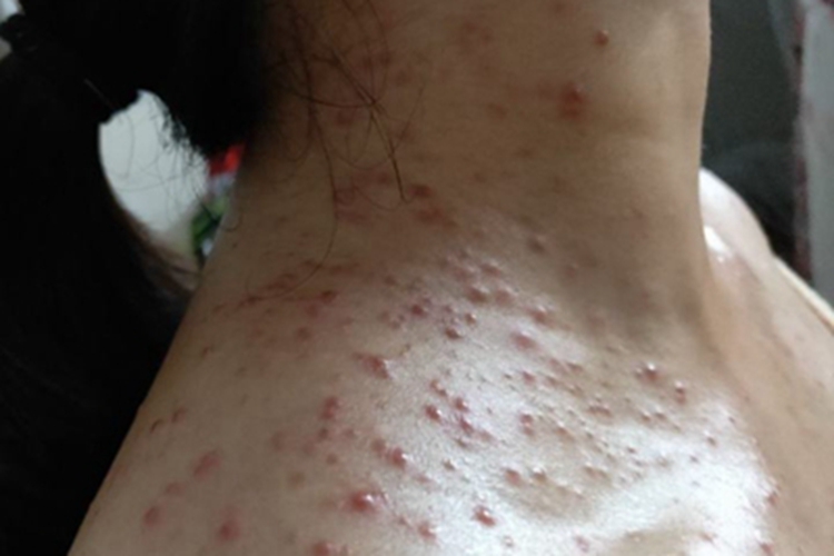 马拉色菌毛囊炎肩部疙瘩图