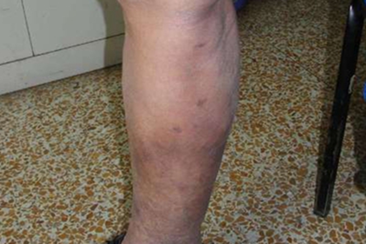 血栓性浅静脉炎起硬块图