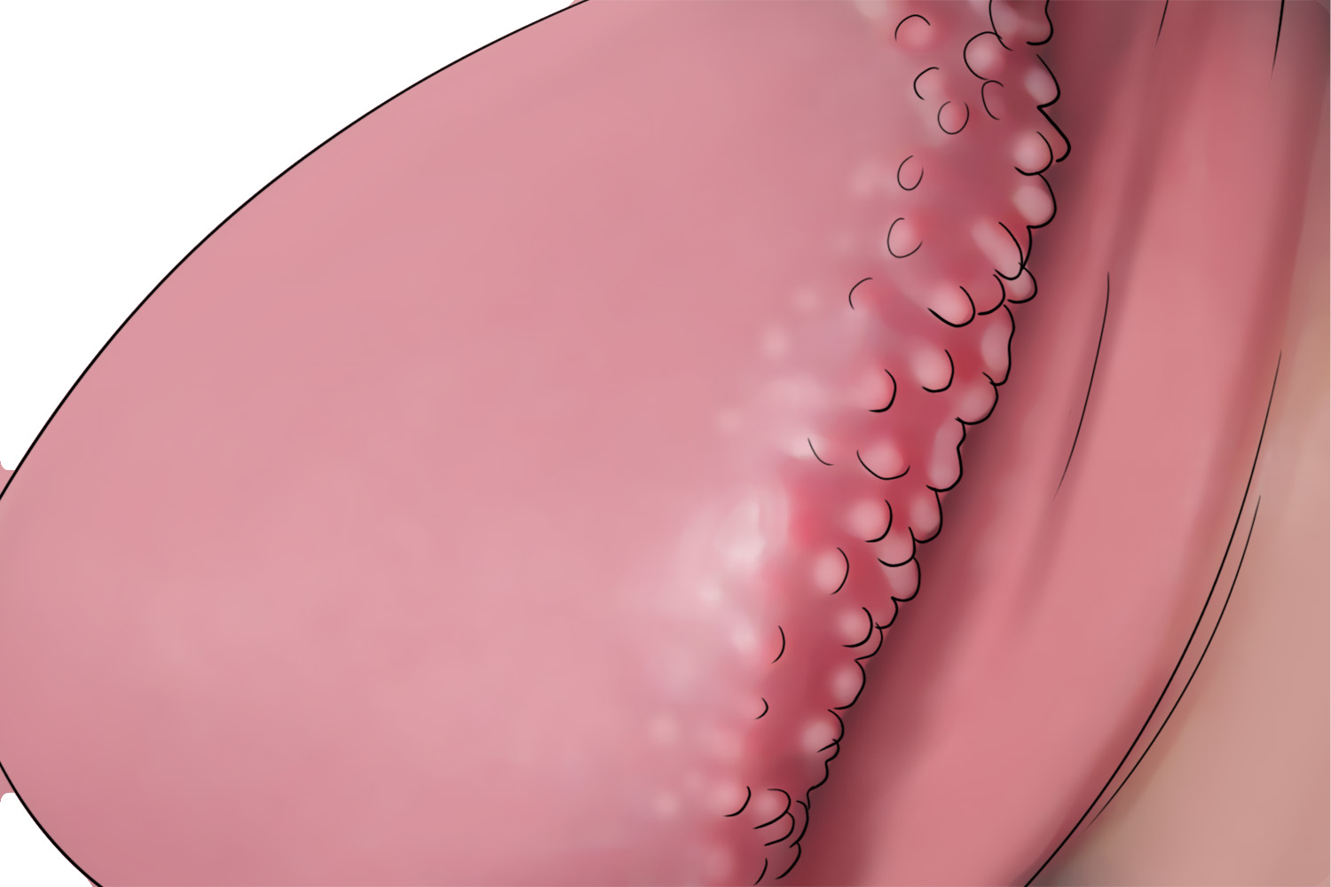 珍珠状阴茎丘疹图