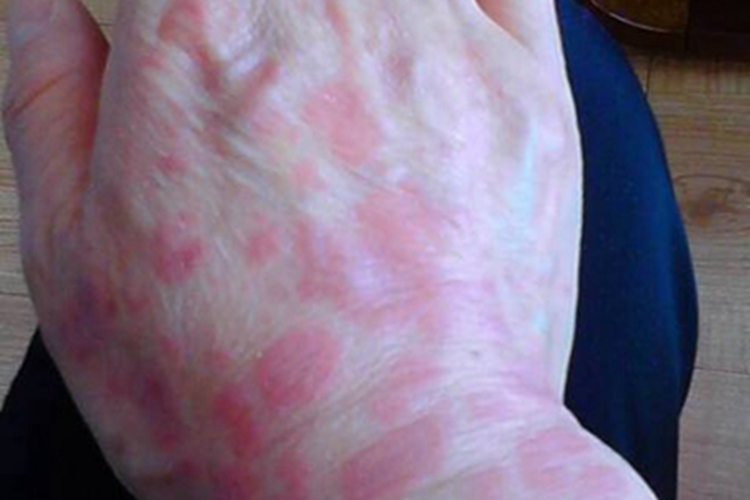 多形红斑型多形性日光疹症状图