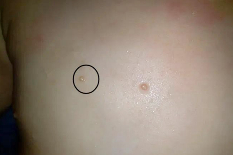 胸口传染性软疣图