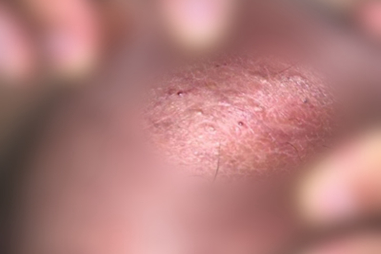 阴囊血管角化瘤会阴部小疙瘩图