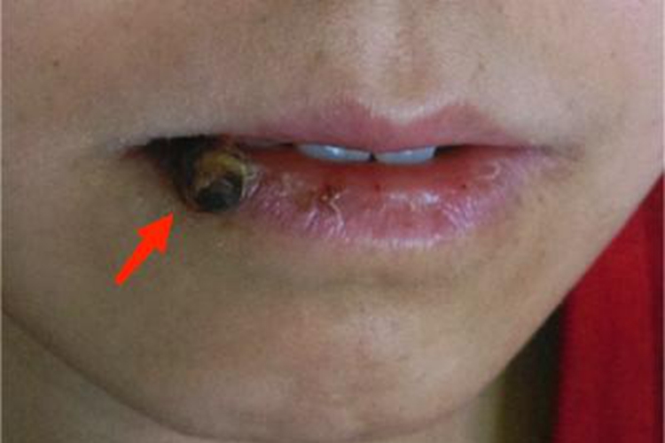 化脓性腺性唇炎疙瘩图 化脓性腺性唇炎疙瘩图