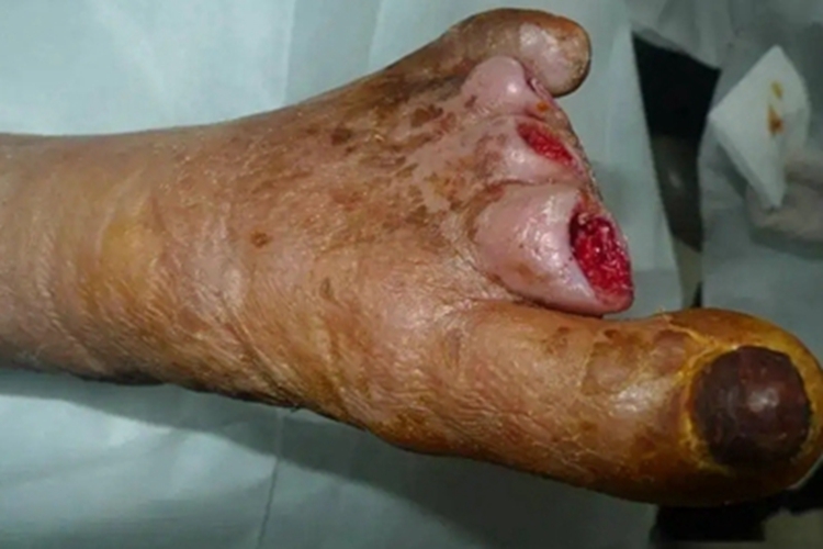 湿性坏疽缺损图 湿性坏疽缺损图