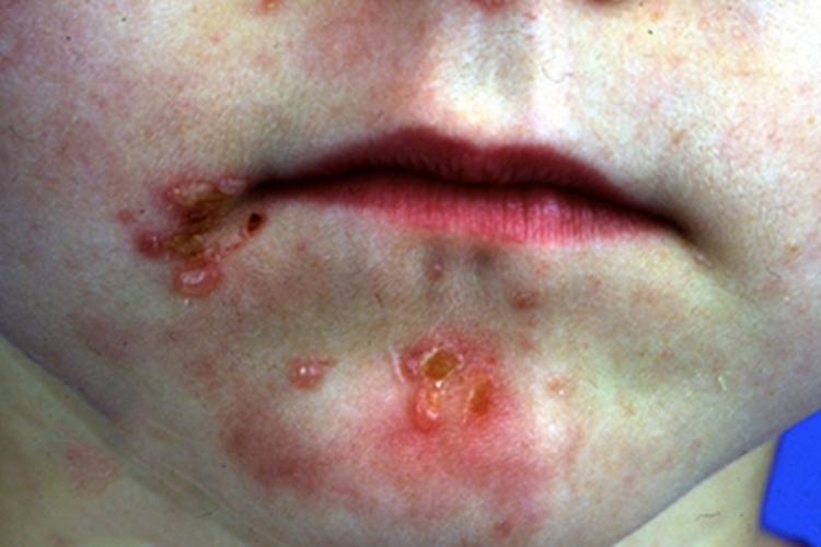 大疱性表皮松解症下巴结痂图 大疱性表皮松解症下巴结痂图