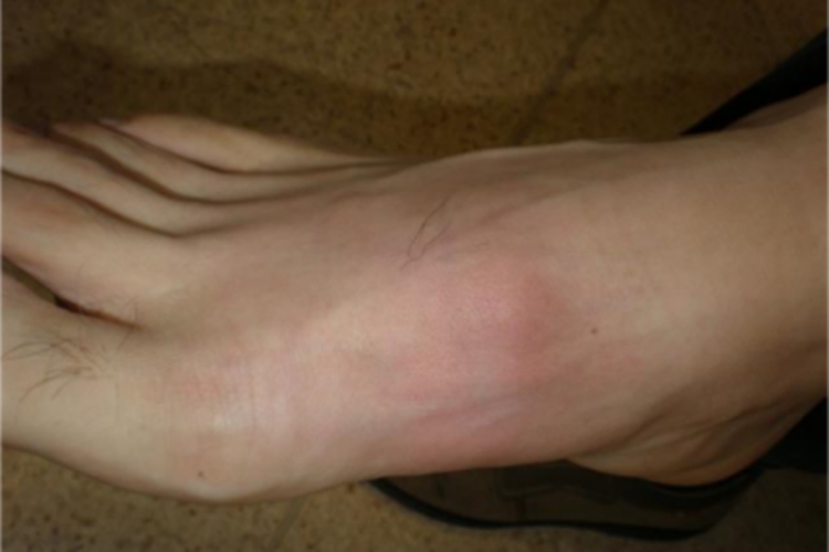 儿童结节性多动脉炎小疙瘩图