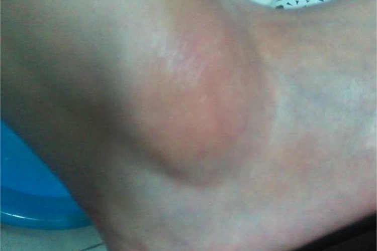 轻度扭伤脚踝症状图