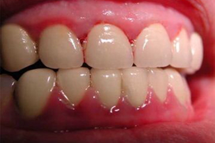 急性坏死性溃疡性龈炎牙龈症状图 急性坏死性溃疡性龈炎牙龈症状图