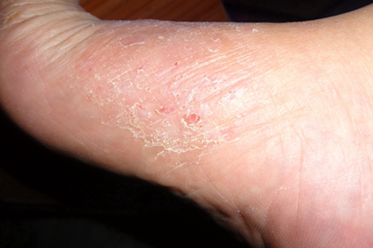 癣菌疹脚部脱屑图 癣菌疹脚部脱屑图