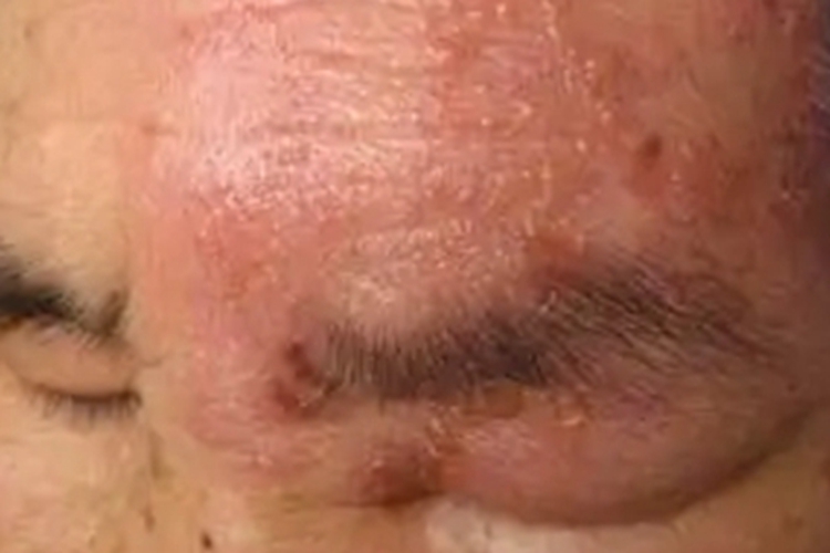 单纯疱疹额头有红斑图