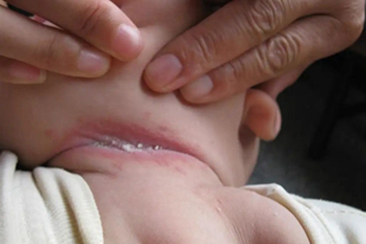 念珠菌性间擦疹红斑图