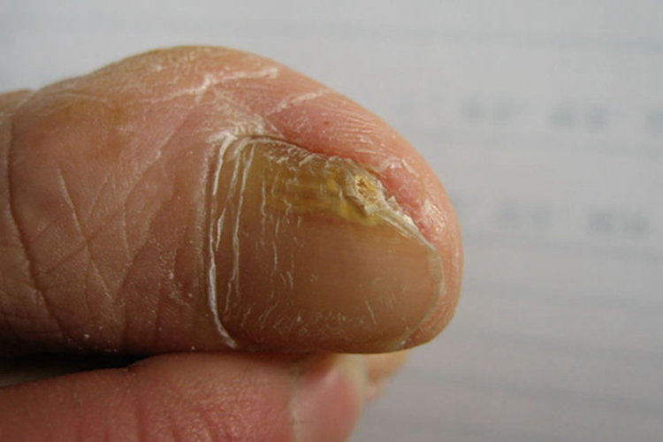 远端侧位甲下型甲真菌病图