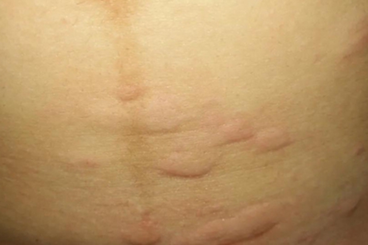 荨麻疹型药疹腹部疙瘩图 荨麻疹型药疹腹部疙瘩图