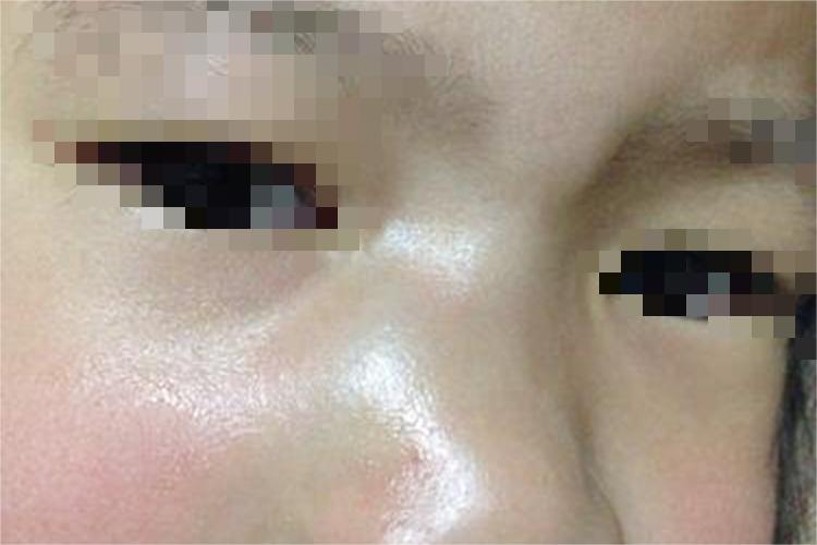 幼儿鼻梁骨折图