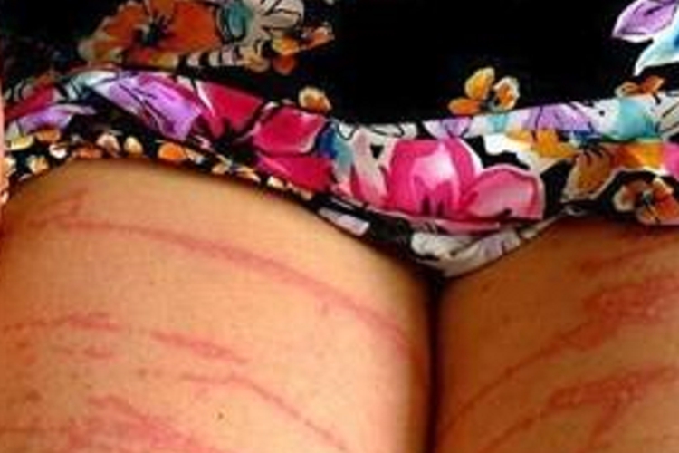 海蜇蜇伤条纹图 海蜇蜇伤条纹图