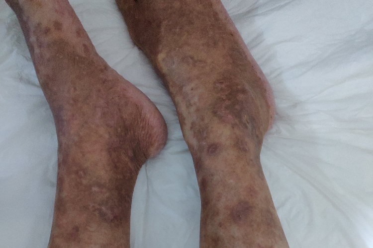 青斑性血管病脚踝红斑图