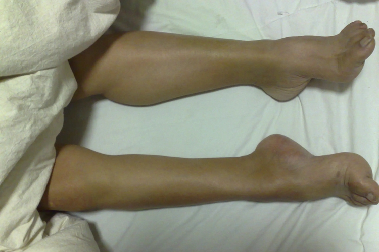 弓形足图 弓形足图