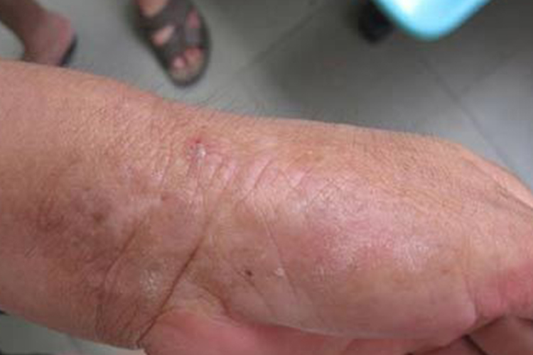 皮肤发红干燥皱缩图 皮肤发红干燥皱缩图