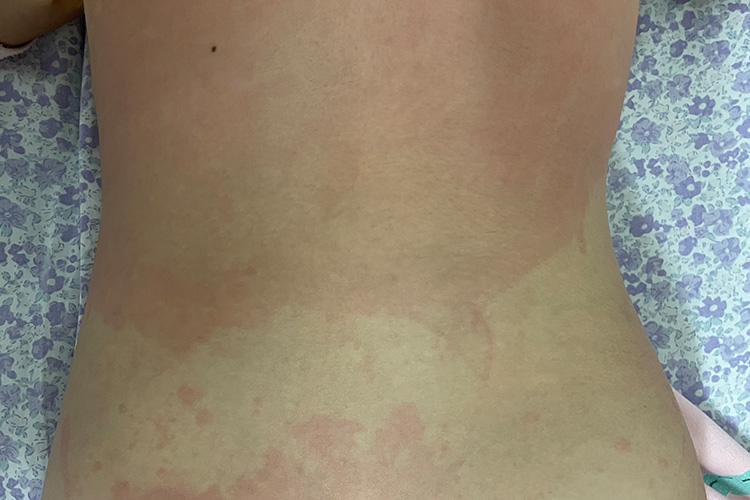 儿童荨麻疹皮损图