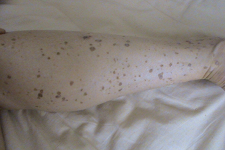 职业性疣赘小腿斑图