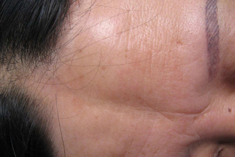 刀砍状硬皮病图 刀砍状硬皮病图