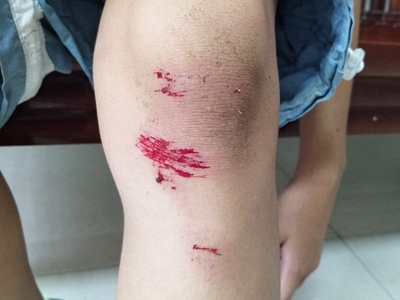 跌伤膝盖内侧有条纹状的裂口伴有渗血图.jpg