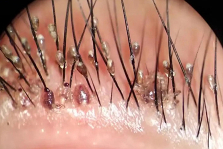 阴虱病睫毛症状图